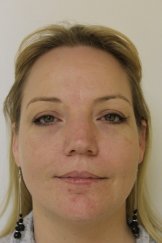 Vampire Facial 4 - After Treatment